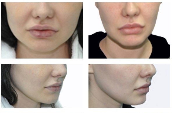 fat-removal-e1727706750974.jpg